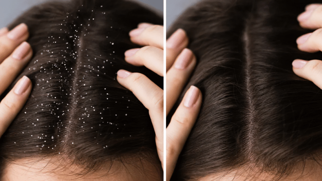Best Home Remedies for Dandruff That Actually Work Fast